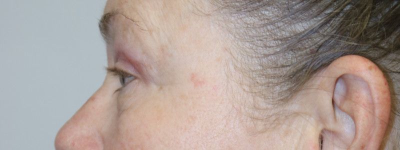 Upper Blepharoplasty Before & After