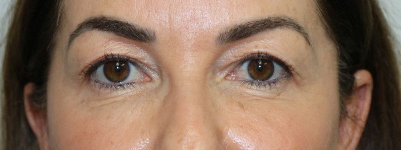 Upper Blepharoplasty Before & After
