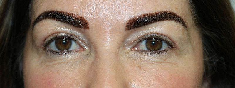 Upper Blepharoplasty Before & After