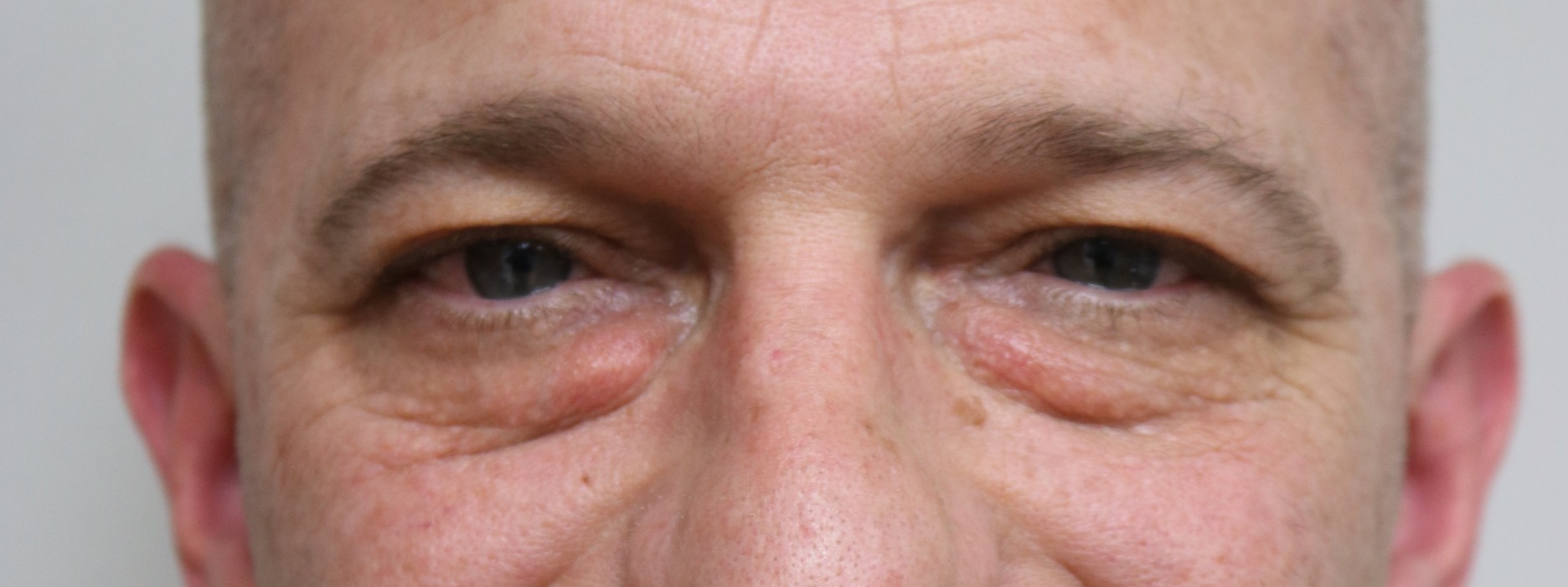 Upper Blepharoplasty Before & After