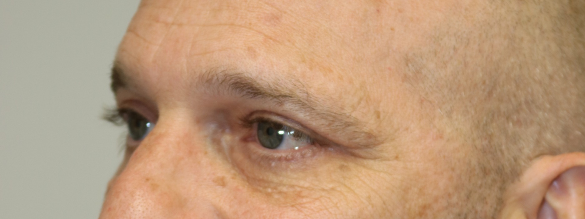 Upper Blepharoplasty Before & After