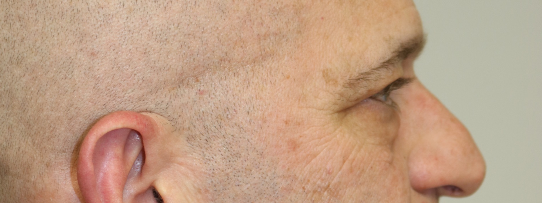 Upper Blepharoplasty Before & After