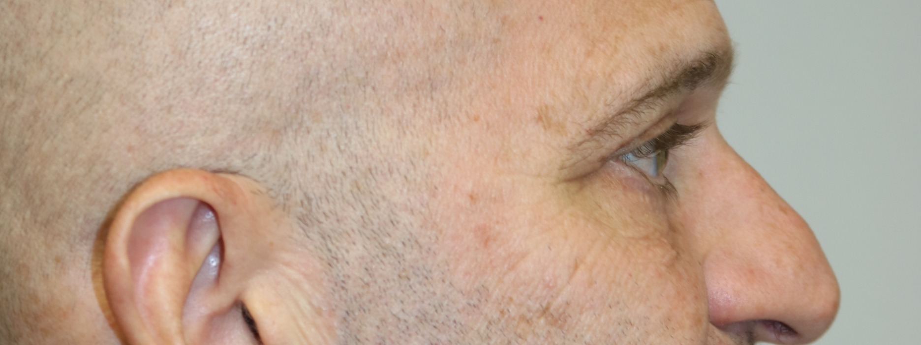 Upper Blepharoplasty Before & After