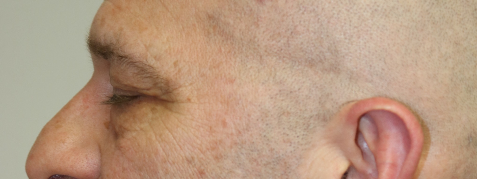 Upper Blepharoplasty Before & After