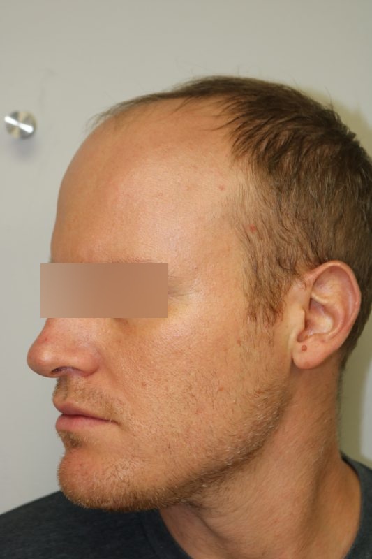 Hair Transplant Before & After