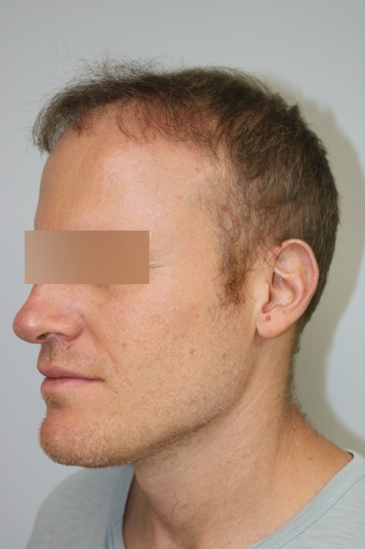 Hair Transplant Before & After