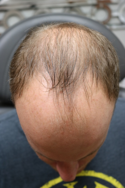 Hair Transplant Before & After