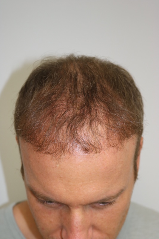 Hair Transplant Before & After