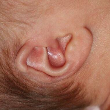 Ear Molding Before & After Image