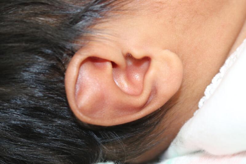 Ear Molding Before & After Image