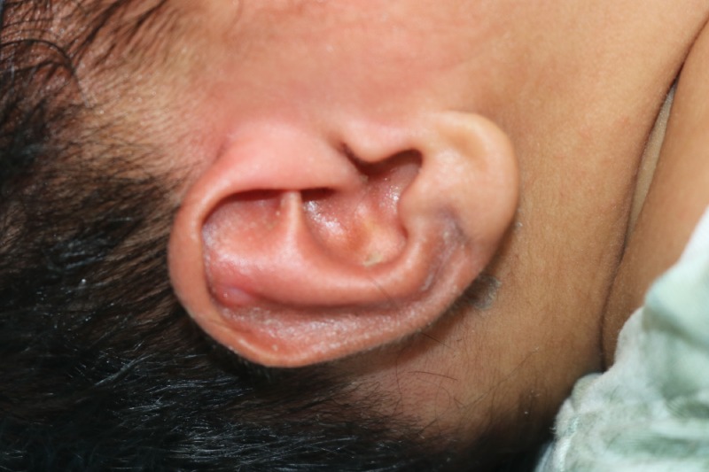 Ear Molding Before & After Image