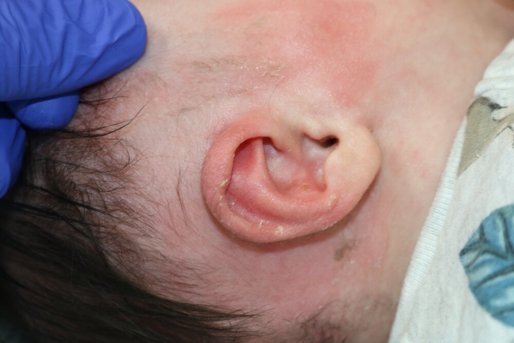 Ear Molding Before & After