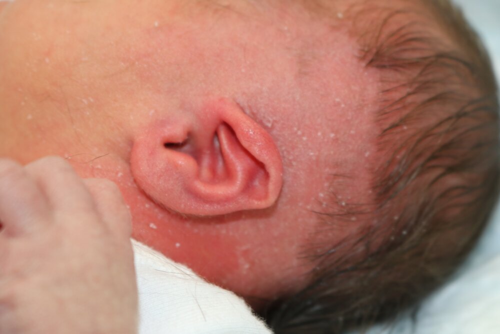 Ear Molding Before & After