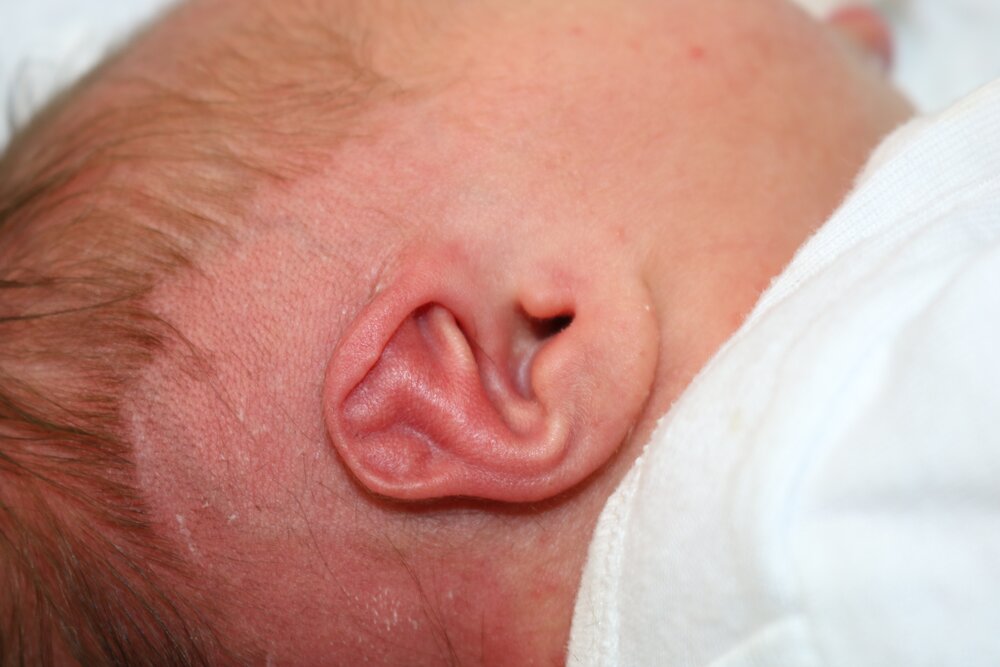 Ear Molding Before & After
