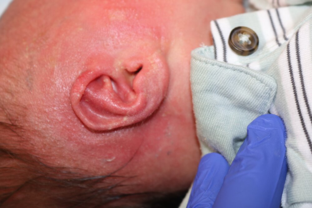 Ear Molding Before & After