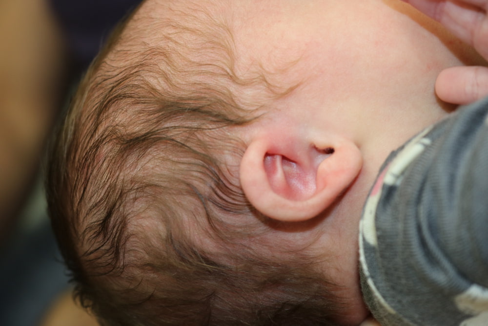 Ear Molding Before & After