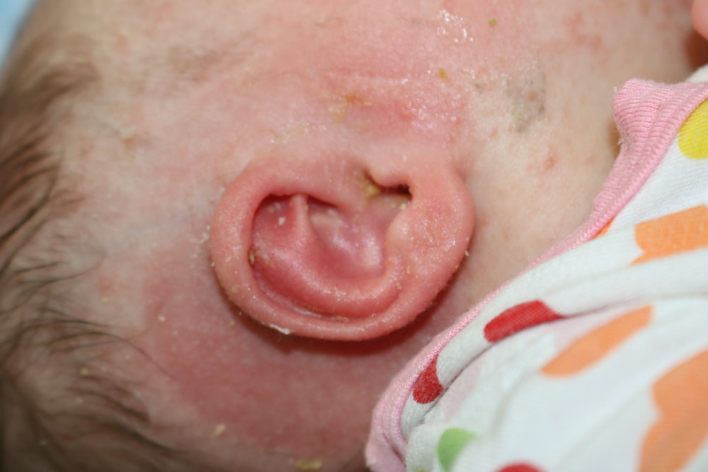 Ear Molding Before & After