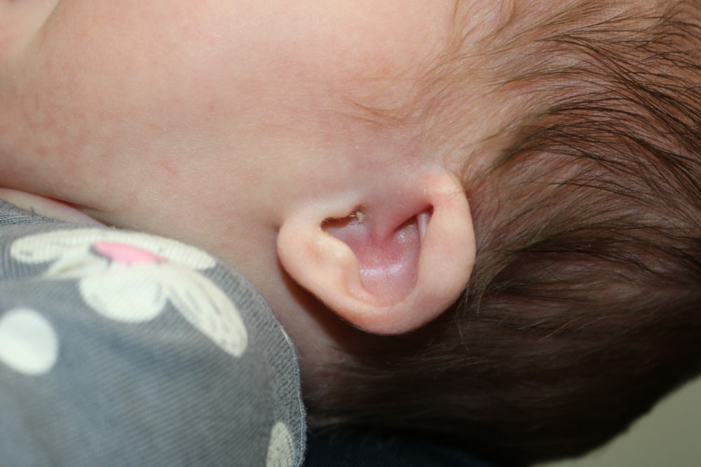 Ear Molding Before & After