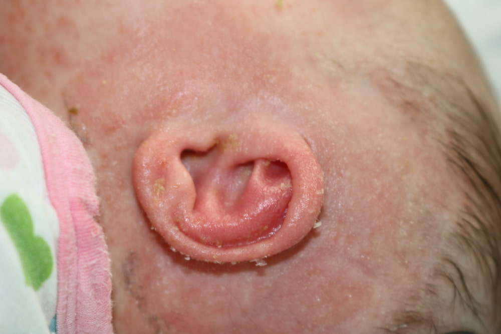 Ear Molding Before & After