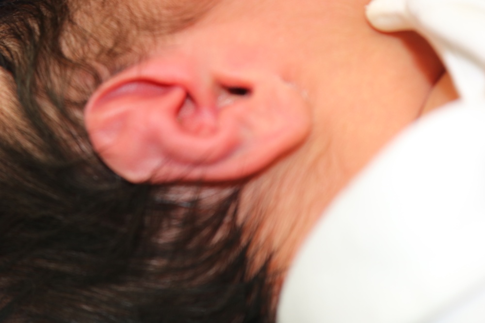 Ear Molding Before & After