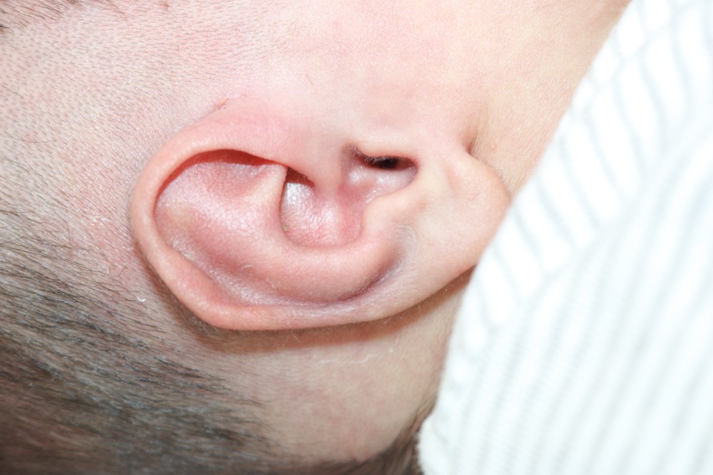 Ear Molding Before & After