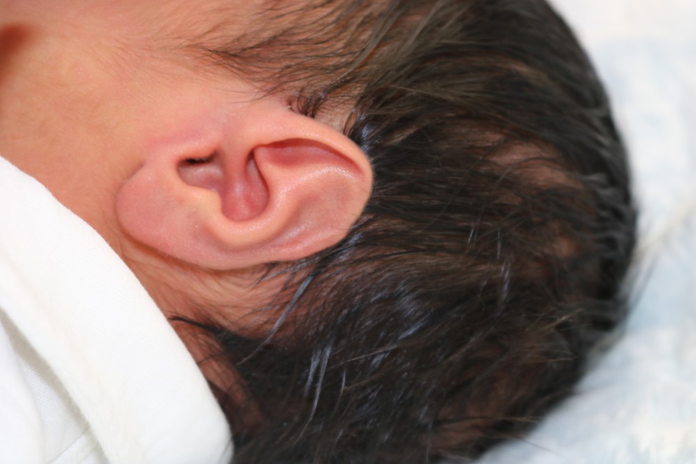 Ear Molding Before & After