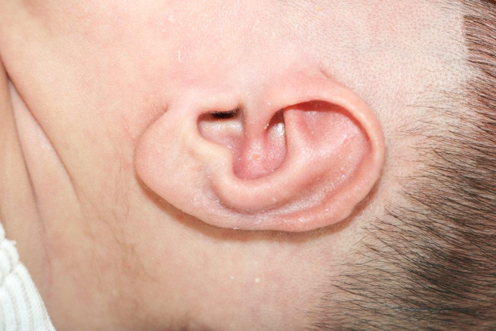 Ear Molding Before & After