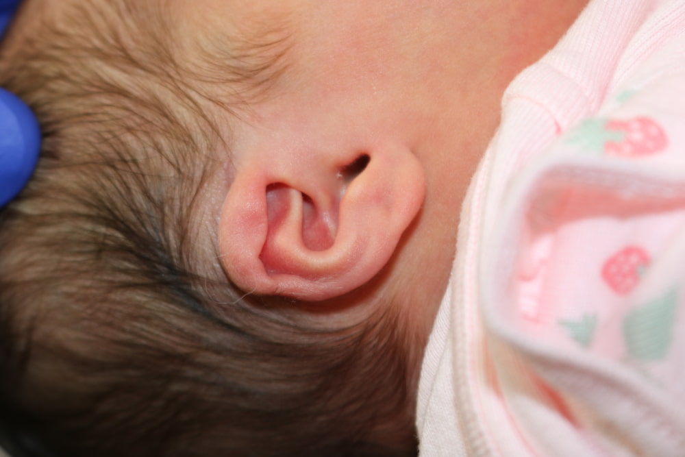 Ear Molding Before & After