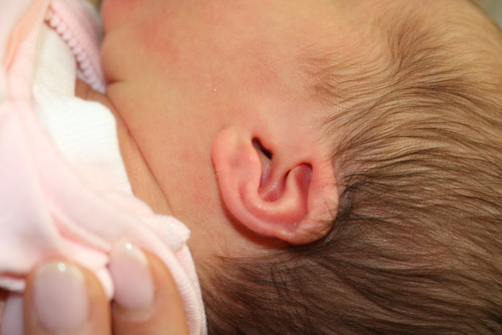 Ear Molding Before & After
