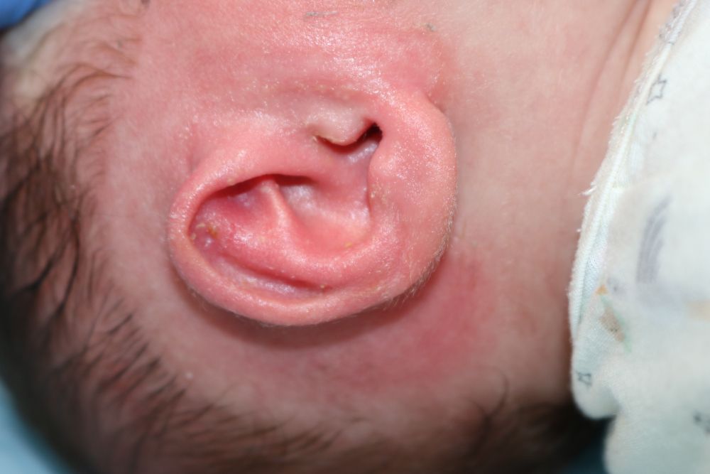 Ear Molding Before & After