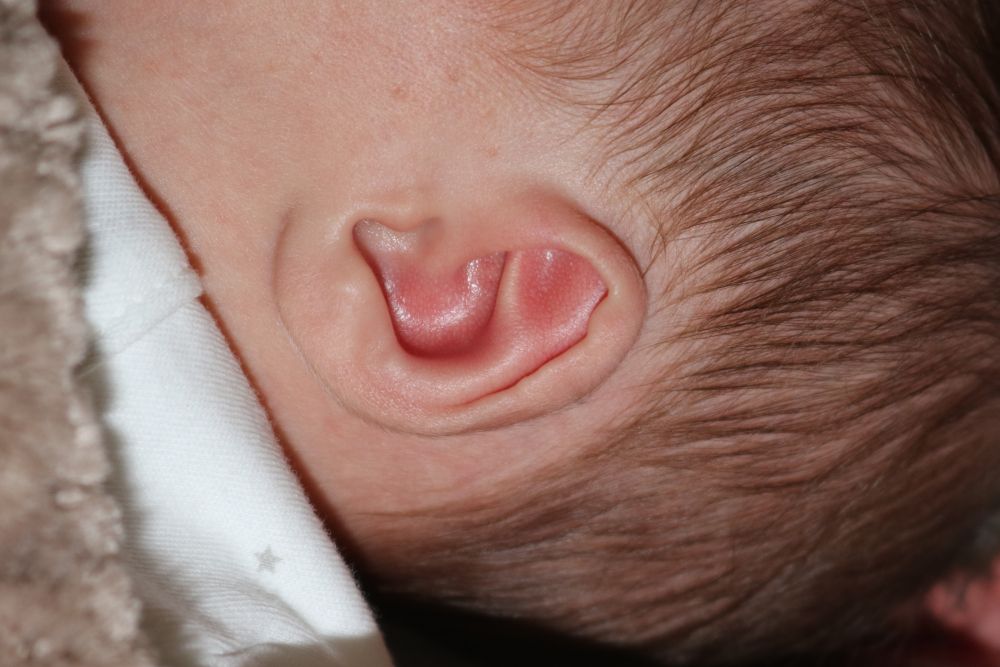 Ear Molding Before & After