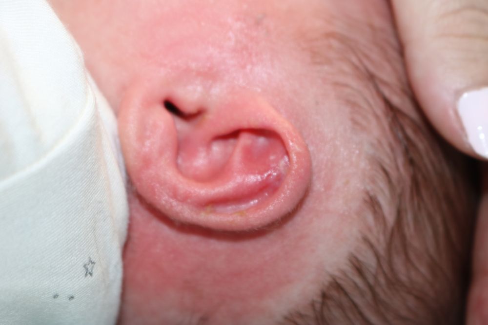 Ear Molding Before & After