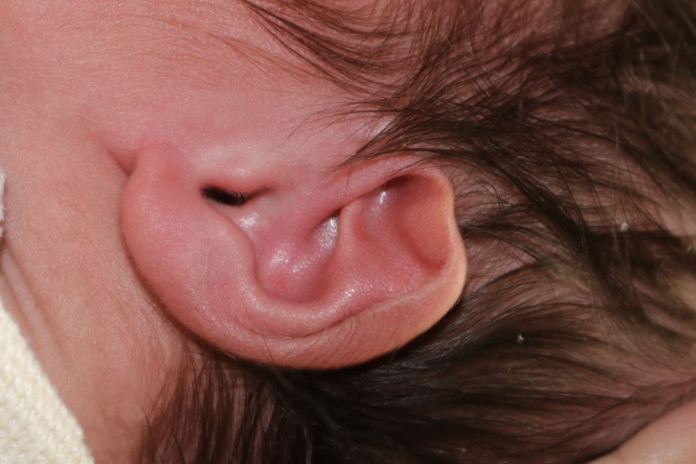 Ear Molding Before & After