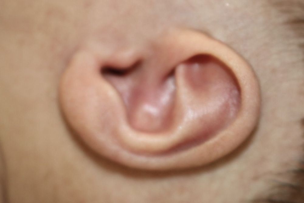 Ear Molding Before & After