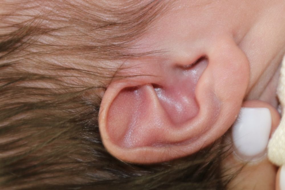 Ear Molding Before & After