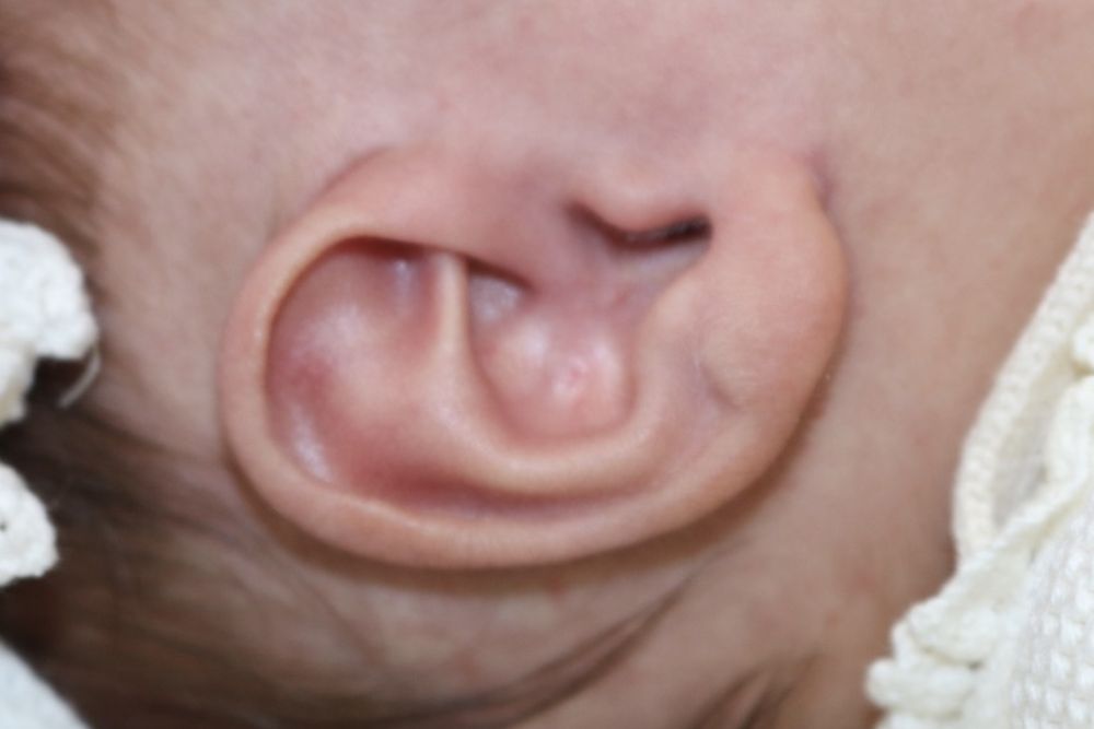 Ear Molding Before & After