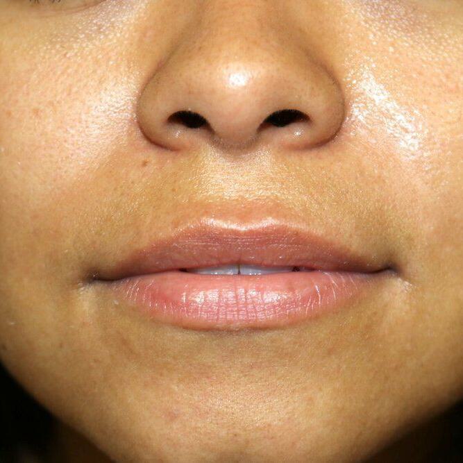 Lip Augmentation Before & After Image