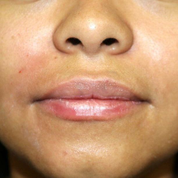 Lip Augmentation Before & After Image