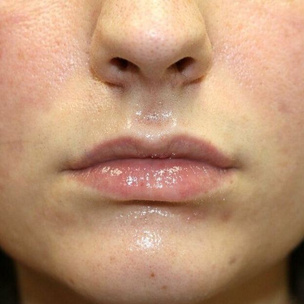 Lip Augmentation Before & After Image