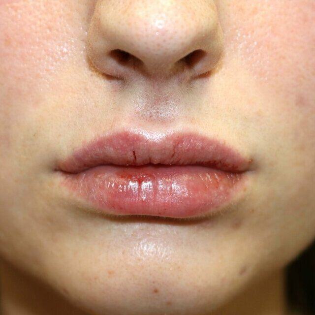 Lip Augmentation Before & After Image