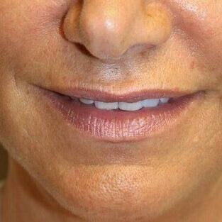 Lip Augmentation Before & After Image