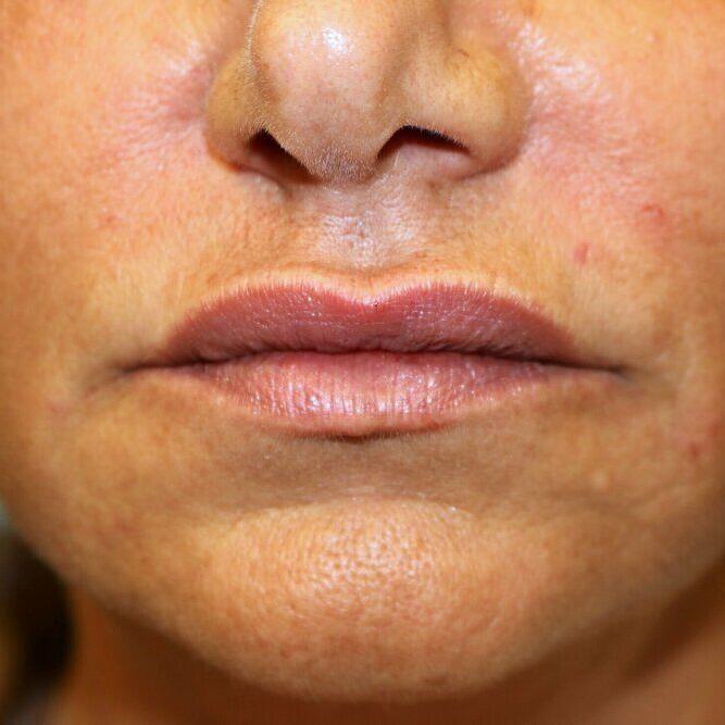 Lip Augmentation Before & After Image