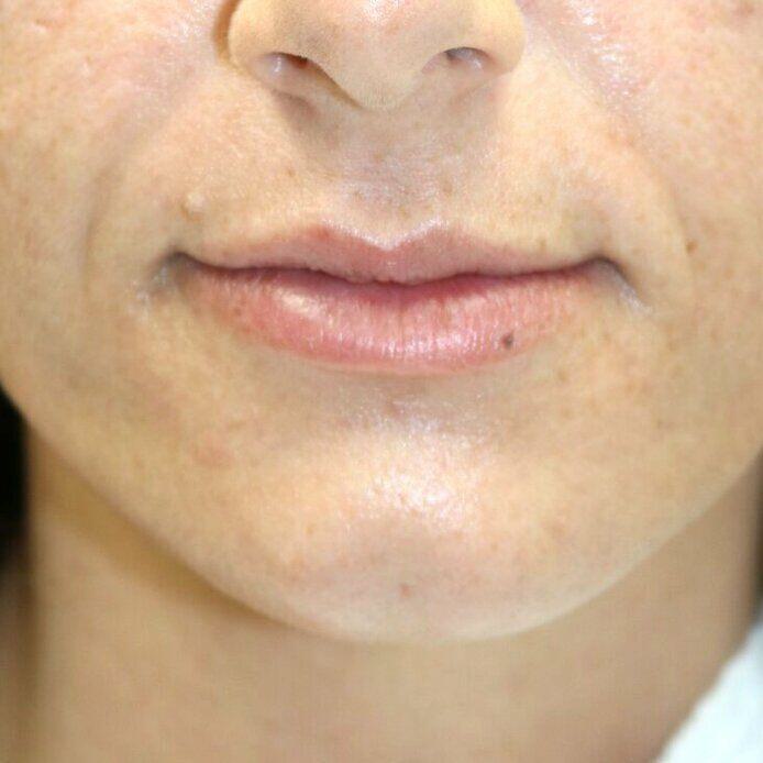 Lip Augmentation Before & After Image