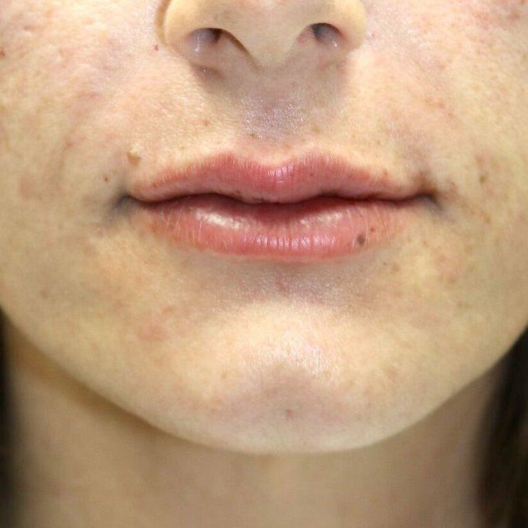 Lip Augmentation Before & After Image