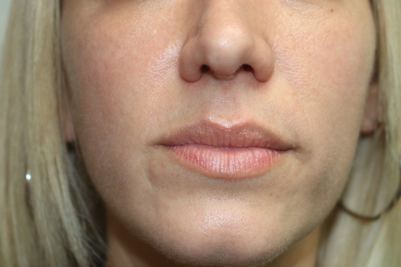 Lip Augmentation Before & After Image