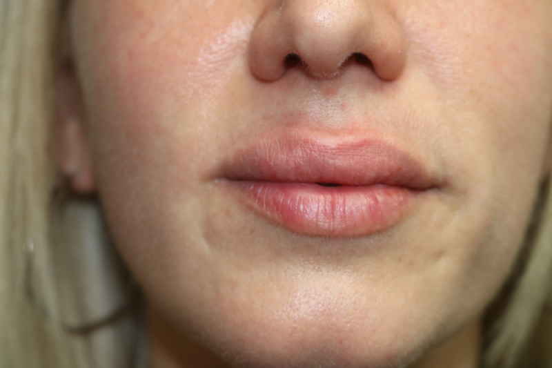 Lip Augmentation Before & After Image