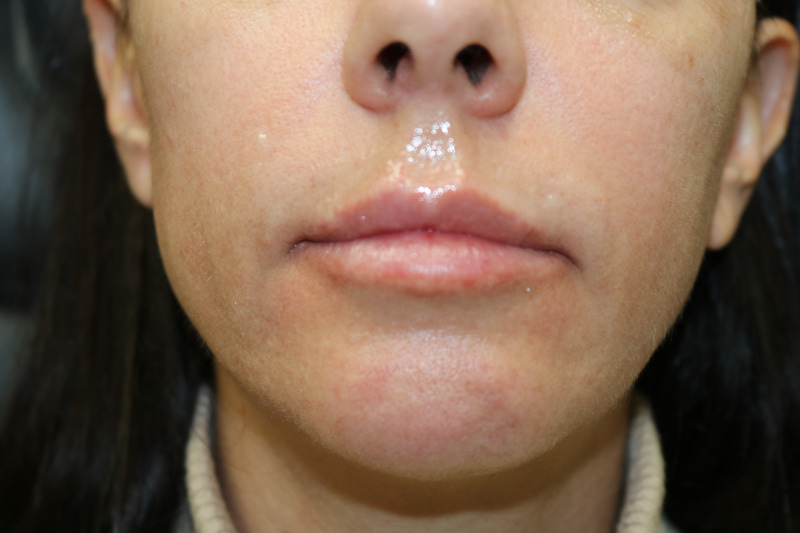 Lip Augmentation Before & After