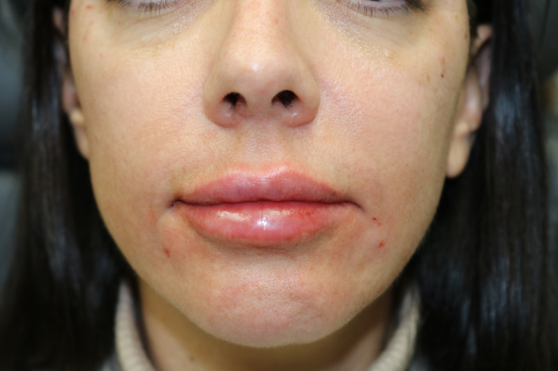 Lip Augmentation Before & After