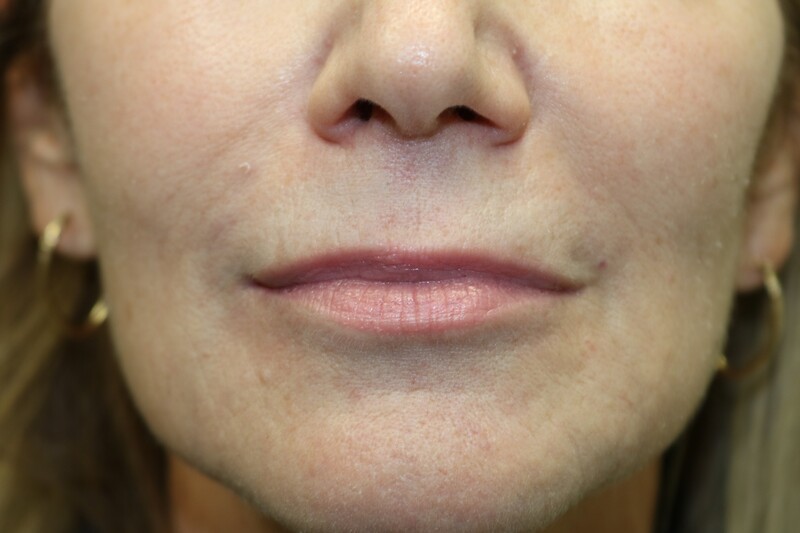 Lip Augmentation Before & After