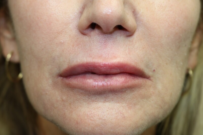 Lip Augmentation Before & After
